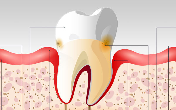 Article-FormsOfPeriodontitis