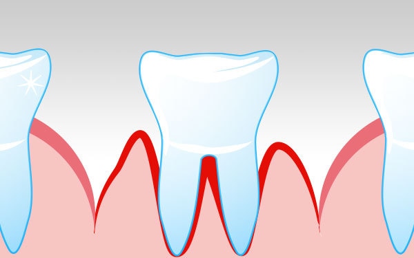 Article-HowPeriodontitisDevelops