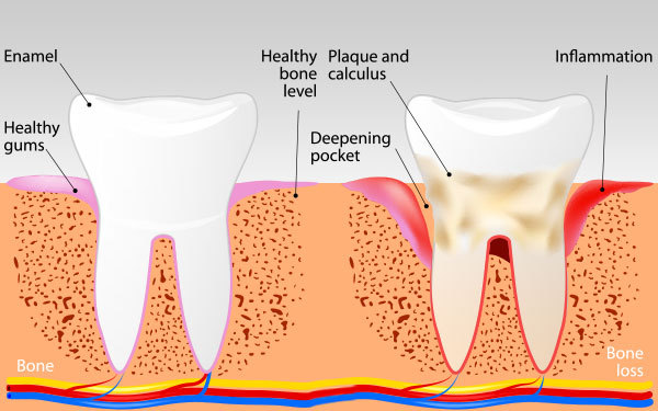 Article-SymptomsOfPeriodontisis