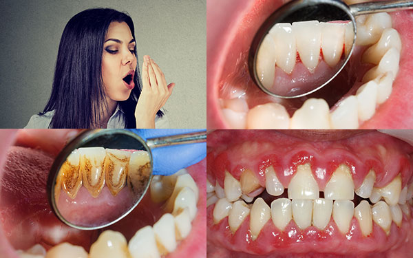 Articles-RisksOfGingivitis