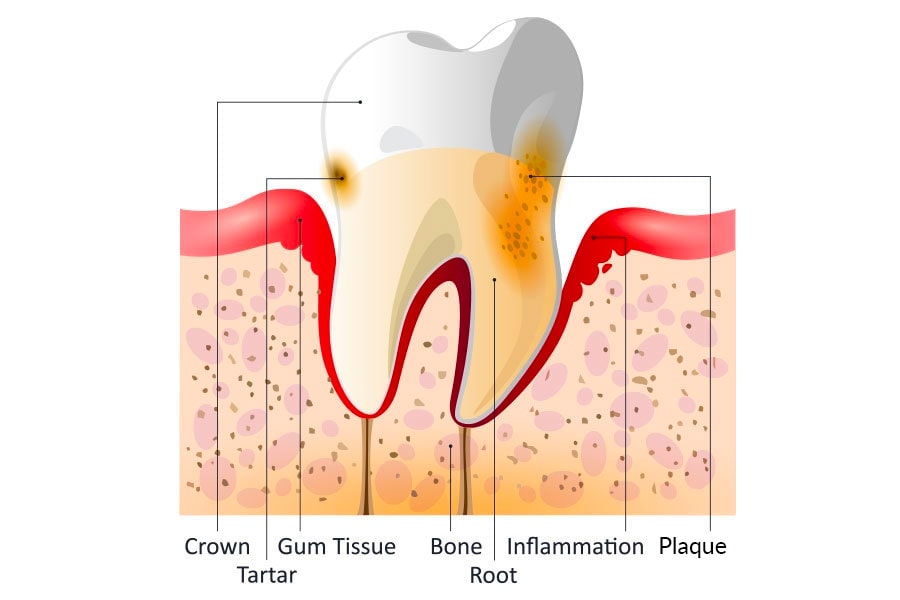 Diagram-Periodontitis